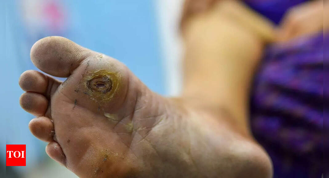 High blood sugar slowly damages your feet: Causes, symptoms and science behind diabetic foot ulcers |